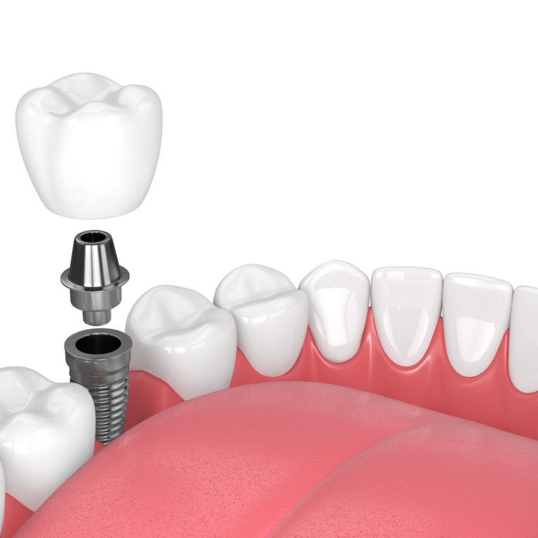3d,Render,Of,Jaw,With,Teeth,And,Dental,Molar,Implant