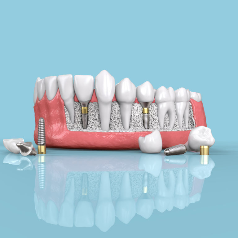 Tooth,Dental,Implant,Model,3d,Illustration